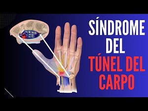 ¿Qué es el Síndrome del Túnel Carpiano?