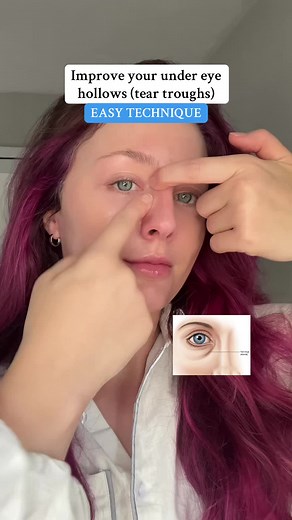How to Improve Under Eye Hollows Naturally