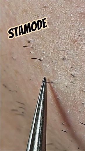 Beard Hair Plucking ASMR 🧔 #beard #tweezing #plucking #satisfying