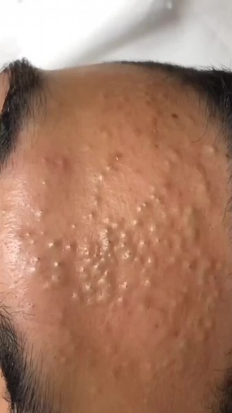 Daily videos! Dm for credits or removal #pimple #acne #pimples #blackheads #pimplepopping #skincare #blackhead #pimplepopper #whiteheads #pimplepoppers #whitehead #blackheadextraction #blackheadremoval #cyst #pimplepop #drpimplepopper #pimplesremover #zit #pores #skin #whiteheadextraction #drsandralee #beauty #acnetreatment #cystremoval #zits #whiteheadremoval #jerawat #skincareroutine #pimpleremover