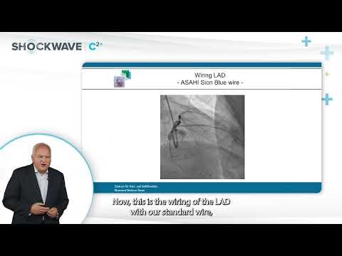 Shockwave C2+ case by Prof Michael Haude & Dr Milad Golabkesh: Heavily Calcified Long LAD Stenosis
