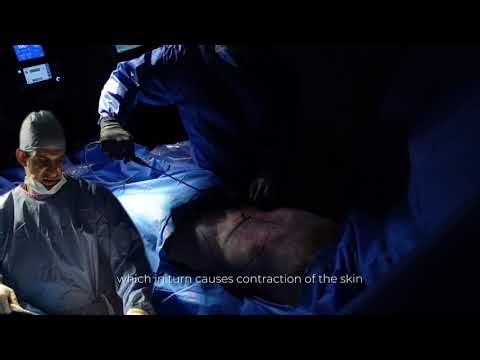 Argo Plasma Skin Tightening by Dr. Metin Nizamoglu | Centre for Surgery | London UK