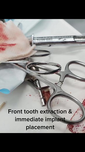 Front tooth implant placement start to finish! #DentalImplants #DrCesar #FYP #FY #Implant #Dentist #ForYou #Surgery #ConfiDENT #Dental #Alpharetta