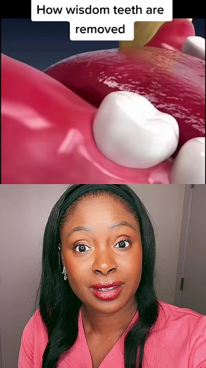 Wisdom Teeth Removal Process Explained by a Dental Hygienist