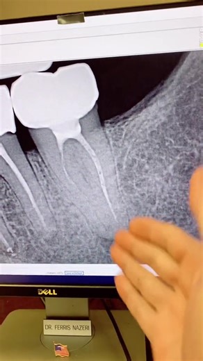 Understanding Root Canal Therapy Processes