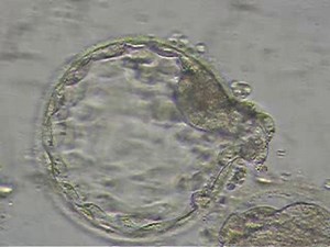 Embryo transfer with Spontaneously hatched Blastocyst at IdealFertilityClinic