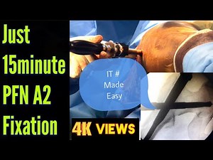 Proximal Femoral Nailing(PFN A2) Step By Step | Free Hand Distal Femoral Locking Surgical Technique.