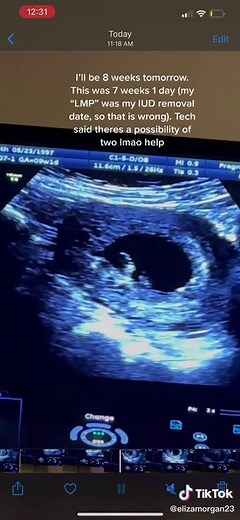 It would explain why I’m so sick lol #pregnant #pregnancy #ultrasound #twins