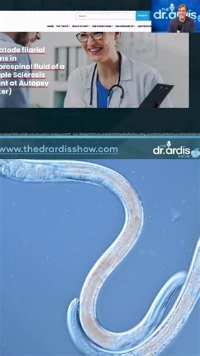 Could parasites play a role in neurological diseases? Some researchers are exploring whether these tiny organisms might influence conditions like multiple sclerosis (MS), Alzheimer’s, or dementia. What are your thoughts? Video credit: @thedrardisshow #DrArdis #Neurology #MS #Alzheimers #Dementia #BrainHealth #Parasites #Autoimmune #NeuroScience #HealthResearch #MedicalResearch #BrainDiseases #NeurologicalHealth #Wellness #MindHealth #drclark #drclarkstore | Dr. Clark Store