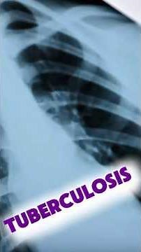 5 Must-Know Facts About Tuberculosis 🫁🦠#nursing #microbiology