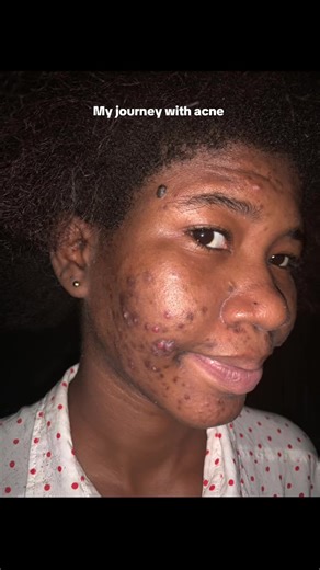 My Journey with Acne: Healing and Skincare Tips