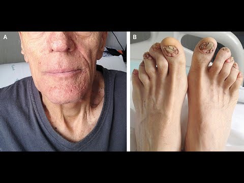 Tuberous sclerosis Complex TSC; genetic disorder that affects multiple organ systems