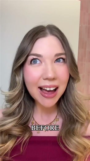 Invisalign transformation