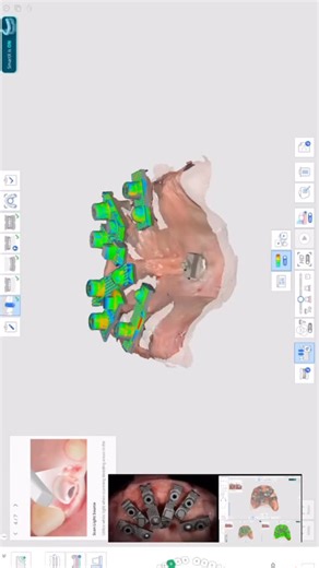 Scan Ladder on Instagram: "Digital workflow example shared by Dr. Jorge Troncoso Pazos (@dr.jorgetroncosop) Always useful to see how different clinicians approach digital planning and workflow structure in everyday practice! Learn more about Scan Ladder: www.scanladder.com"