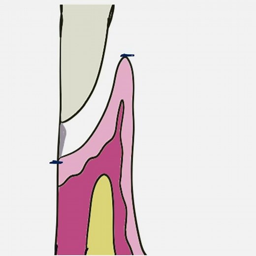 Probing Pocket Depth V/S Clinical Attachment Level #shorts #periohub