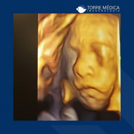 ¿Qué es un ultrasonido obstétrico estructural? #ultrasonido #embarazo #obstetricoestructural