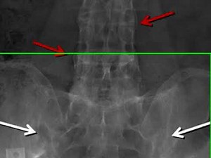Sacroiliitis Frcr Radiology