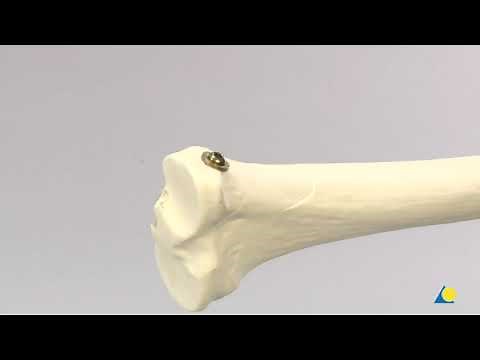 AO Internal Fixation with Screws and Plates Providing Absolute Stability