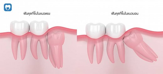 ฟันคุด คืออะไร มีกี่แบบ ราคาเท่าไหร่ ทำไมต้องผ่า | Care Dental Clinic