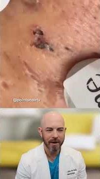 Massive Cyst or Big Blackheads?