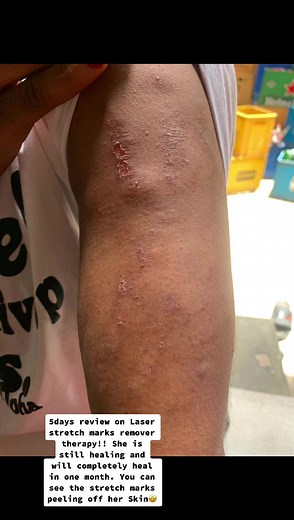 5 Days Review of Laser Stretch Marks Therapy