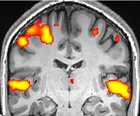 fMRI: Functional Magnetic Resonance Imaging