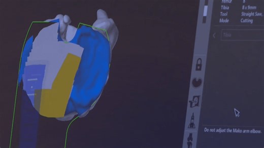 Robotic assistance in knee replacements on the rise