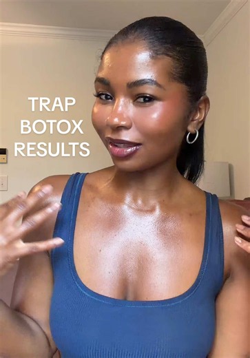 Trap Botox Results: Real Before and After Transformation