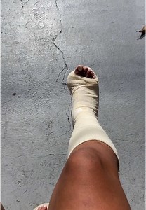 17 Dias Usando Tala: Minha Recuperação da Fratura