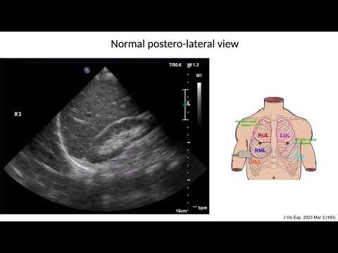 Introduction to Lung Ultrasound, March 2025 POCUS Case of the Month