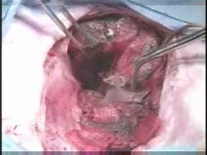 WARNING Graphic but awesome content! Quikclot Sponge demonstration on a pig. | QureMed