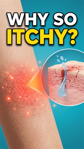 Atopic Eczema Explained: Why Your Skin Gets So Itchy #Eczema #skin #health63health #education