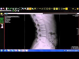 20/20 Imaging Opal-Rad (Chiropractic) Lumbar curve tool