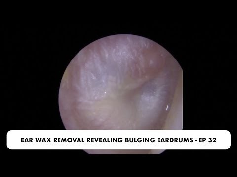 🔴EARDRUM ABOUT TO EXPLODE! 💥EAR WAX REMOVAL - EP 32