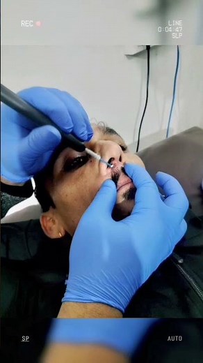 Filiform wart removal