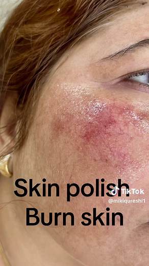 The Dangers of Skin Bleaching Agents for Sensitive Skin