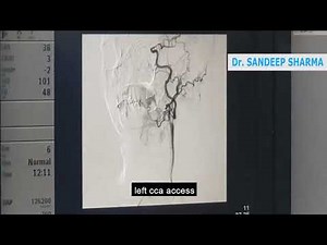CAROTID STENTING WITH SPIDER FILTER