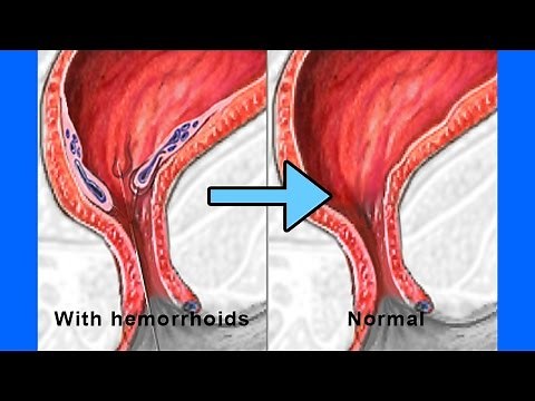 How To Get Rid Of Hemorrhoids in just 2 days - How To Shrink Hemorrhoids Fast and Naturally?