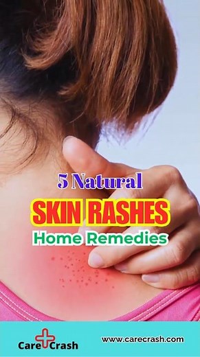 5 Natural Skin Rashes Home Remedies | #carecrash