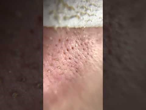 ASMR Satisfying | AMAZING Pore Strips Removal BLACKHEADS NOSE