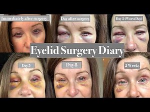 Lower Eyelid Surgery Diary (Blepharoplasty)