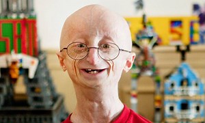 El raro caso de Sam Berns, el adolescente que vivió 17 años en el cuerpo de un anciano