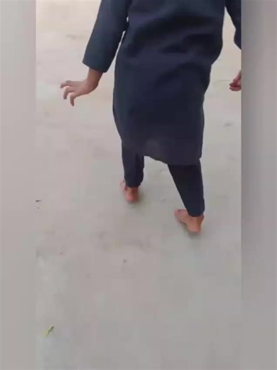 #creatorsearchinsights Tip toe walking ues AFo: AFO An AFO is a supportive brace designed to control ankle and foot movement in children or adults who walk on their toes. It helps position the foot flat on the ground, provides stability to the ankle, prevents contractures, and encourages a normal heel-to-toe walking pattern. By keeping the ankle at a proper angle, the AFO reduces muscle tightness, improves balance, and supports safe mobility during daily activities. اے ایف او AFO ایک معاون تسمہ 