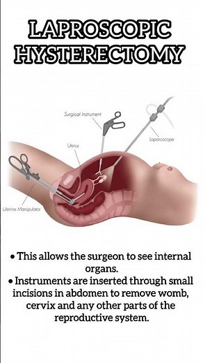 Laparoscopic Hysterectomy I Uterus removal surgery in Delhi Noida