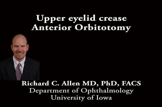 Upper lid crease anterior orbitotomy