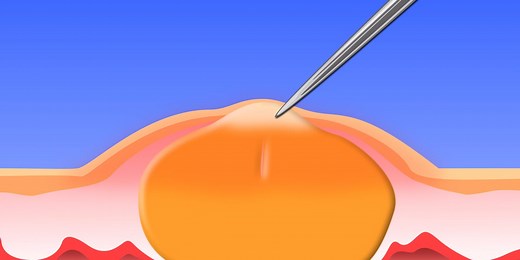 The only right way to pop your pimples