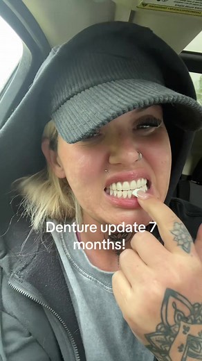 Adjusting to My Immediate Dentures: 7-Month Update
