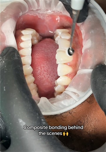 Composite Bonding Process Explained by Dr. Kunal