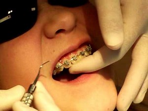 Braces Step-by-Step: Step-15 Remove bottom wire Burleson Orthodontics KCMO