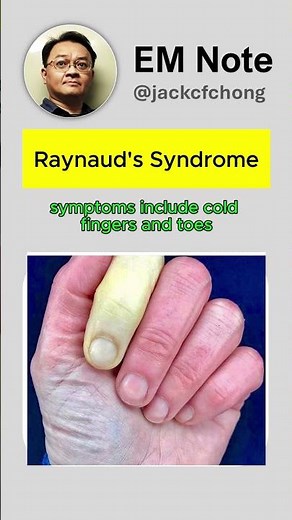 Raynaud's Syndrome